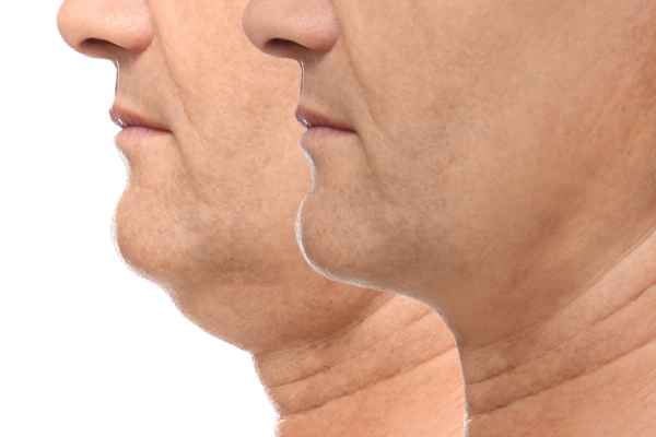 HIFU - Breakthrough in Anti - ageing 2 hifu results Lewes