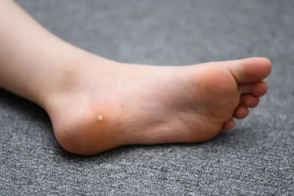 Cryotherapy For Warts And Also Verrucas 2 Image of verruca on the bottom of the foot that able to be treated with Cryotherapy Lewes