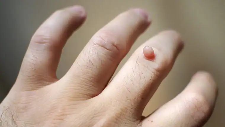Image of blemish that Cryotherapy Lewes can remove with Lipo 360.