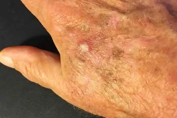 Cryopen For Actinic Keratoses 1 Image of Actinic keratoses Lewes on a person hand