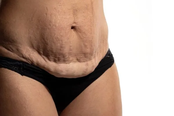 The science behind skin tightening Lewes picture of a woman's sagging skin on the stomach